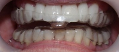 Лечение скрежета зубов народными средствами